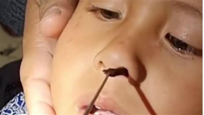 دودة تخرج من أنف طفل