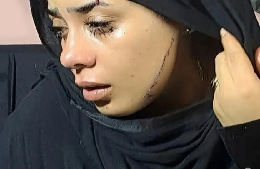 بـ 41 غرزة..طليقة شاب تشوه وجه عروسه قبل زفافهما بمصر القديمة